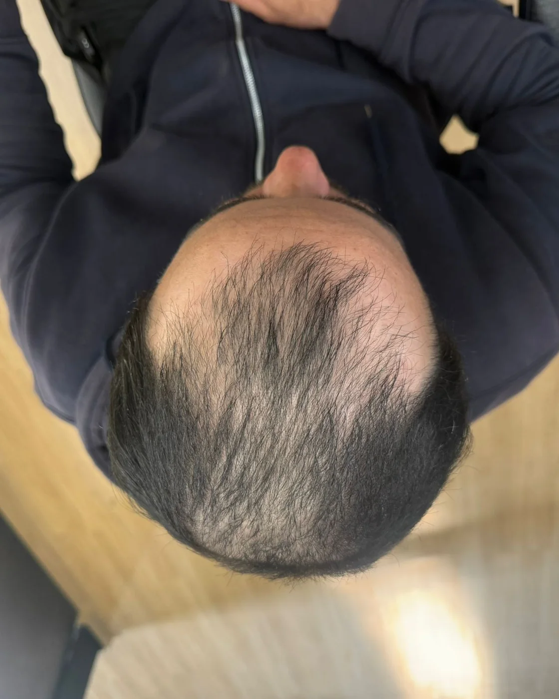 Antes do tratamento de calvície masculina