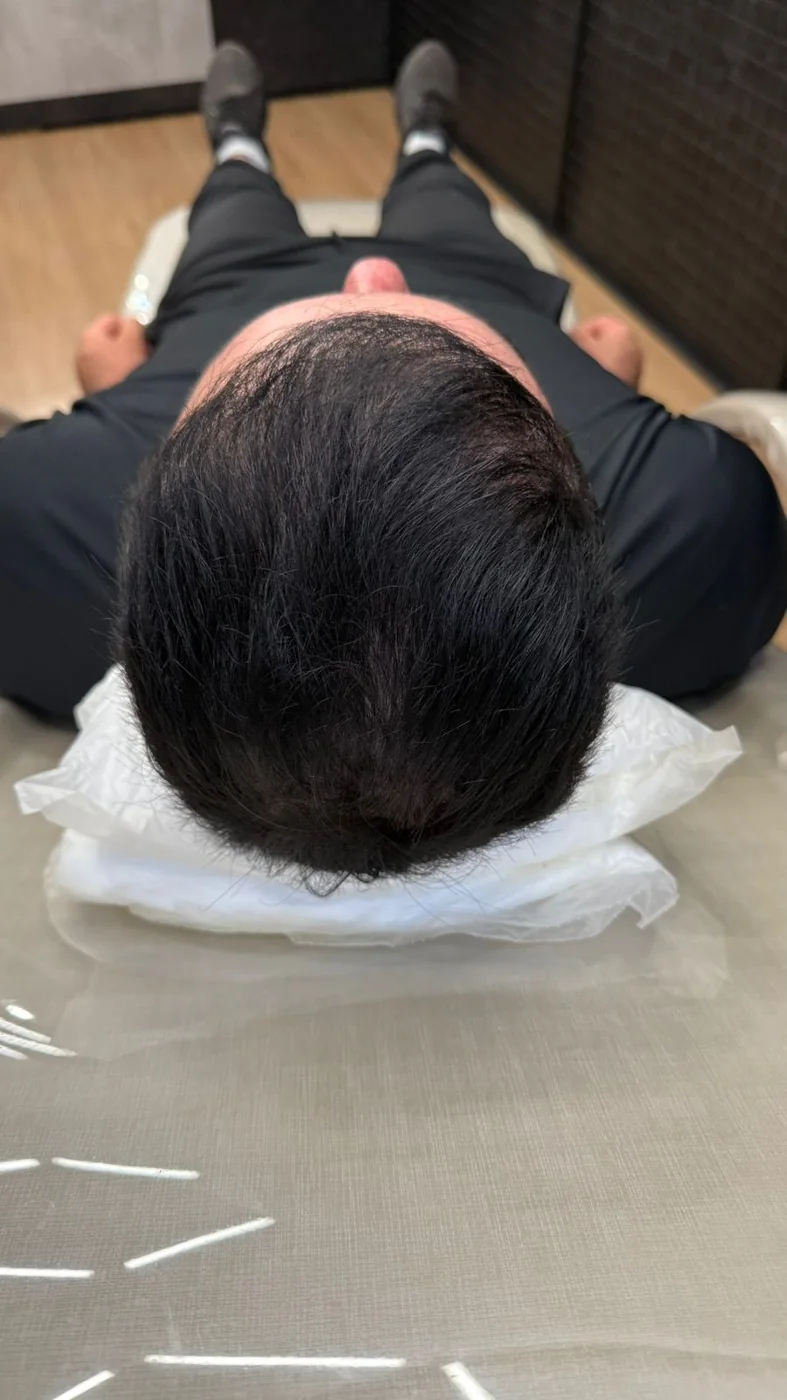 Depois do tratamento de calvície masculina